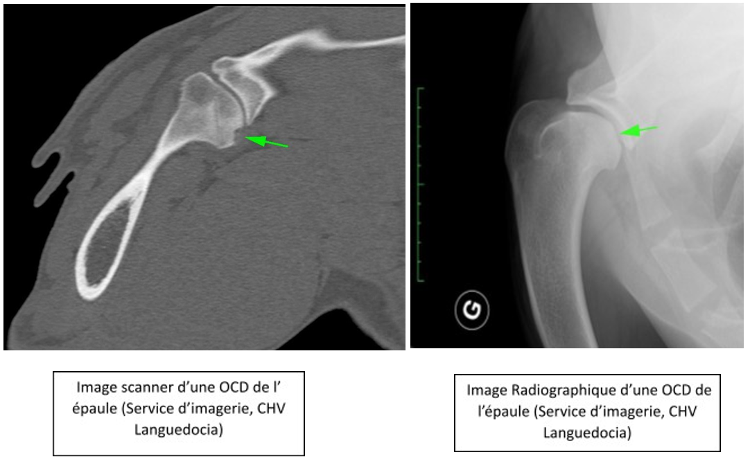 Radiographie et tomodensitométrie de l'épaule côte à côte, les flèches vertes indiquant une anomalie articulaire.