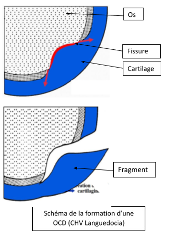 Schéma de formation des lésions d'OCD dans l'os et le cartilage, montrant les stades de fissure et de fragmentation.