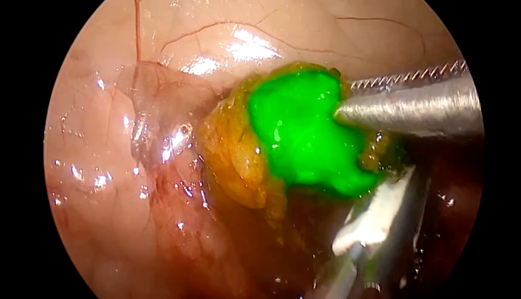 Vue endoscopique d'un tissu coloré en vert vif par un instrument chirurgical