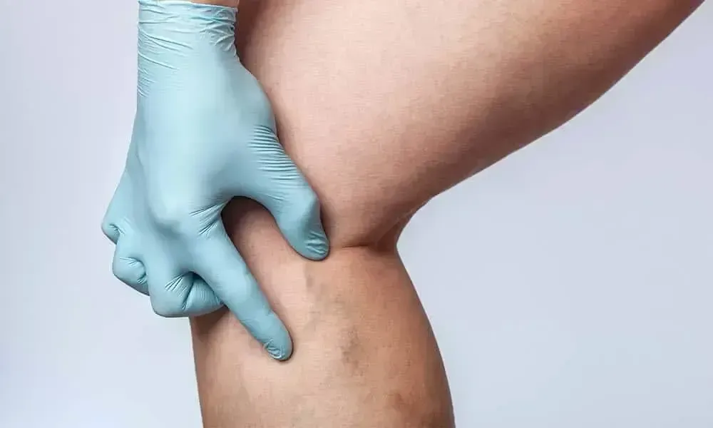 Gloved hand pinching skin on a thigh during a body fat check