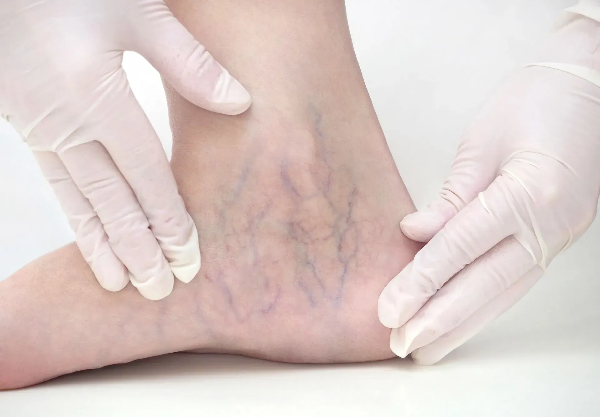 Gloved hands examining blue-veined skin on a leg or ankle