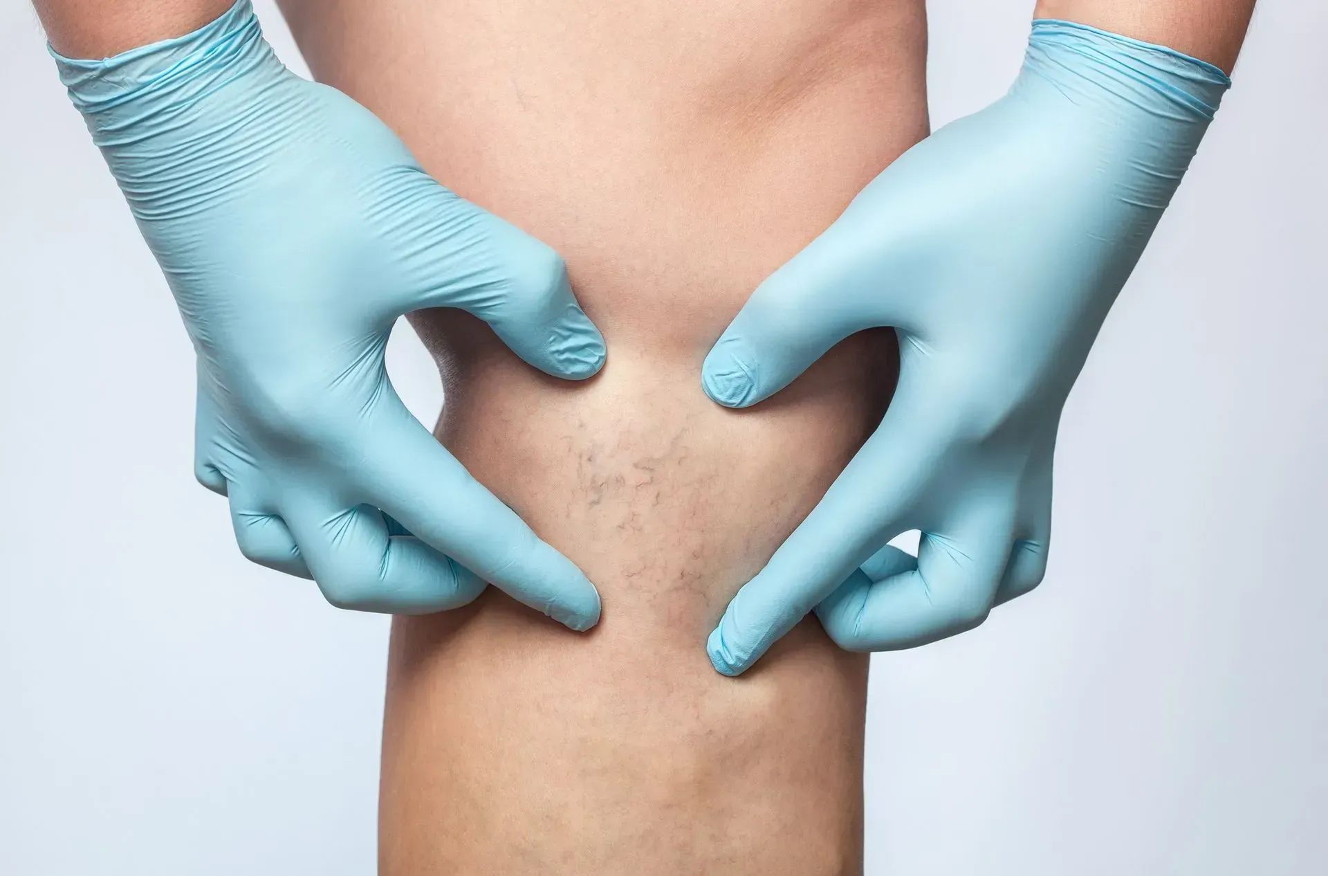 Close-up of hands pinching skin on a bare waist, showing cellulite.