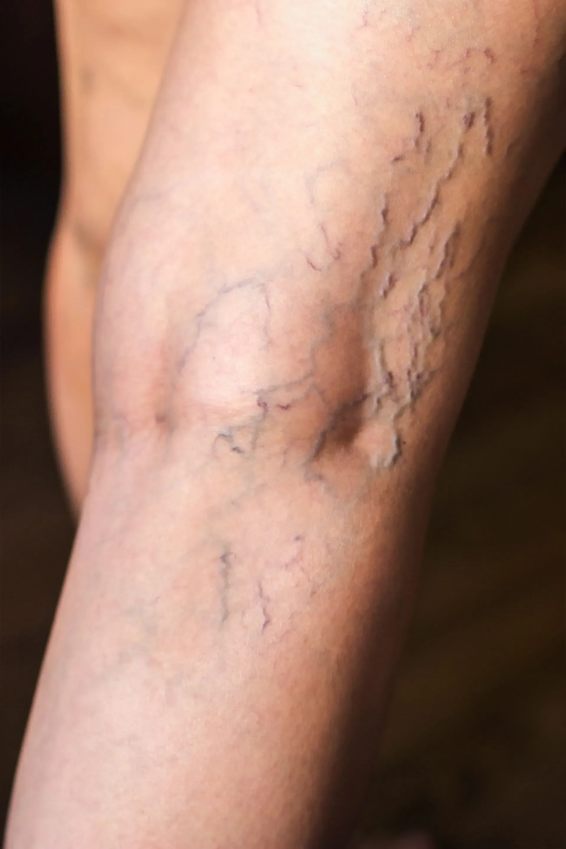 Close-up of a leg with visible blue-purple spider veins near the knee