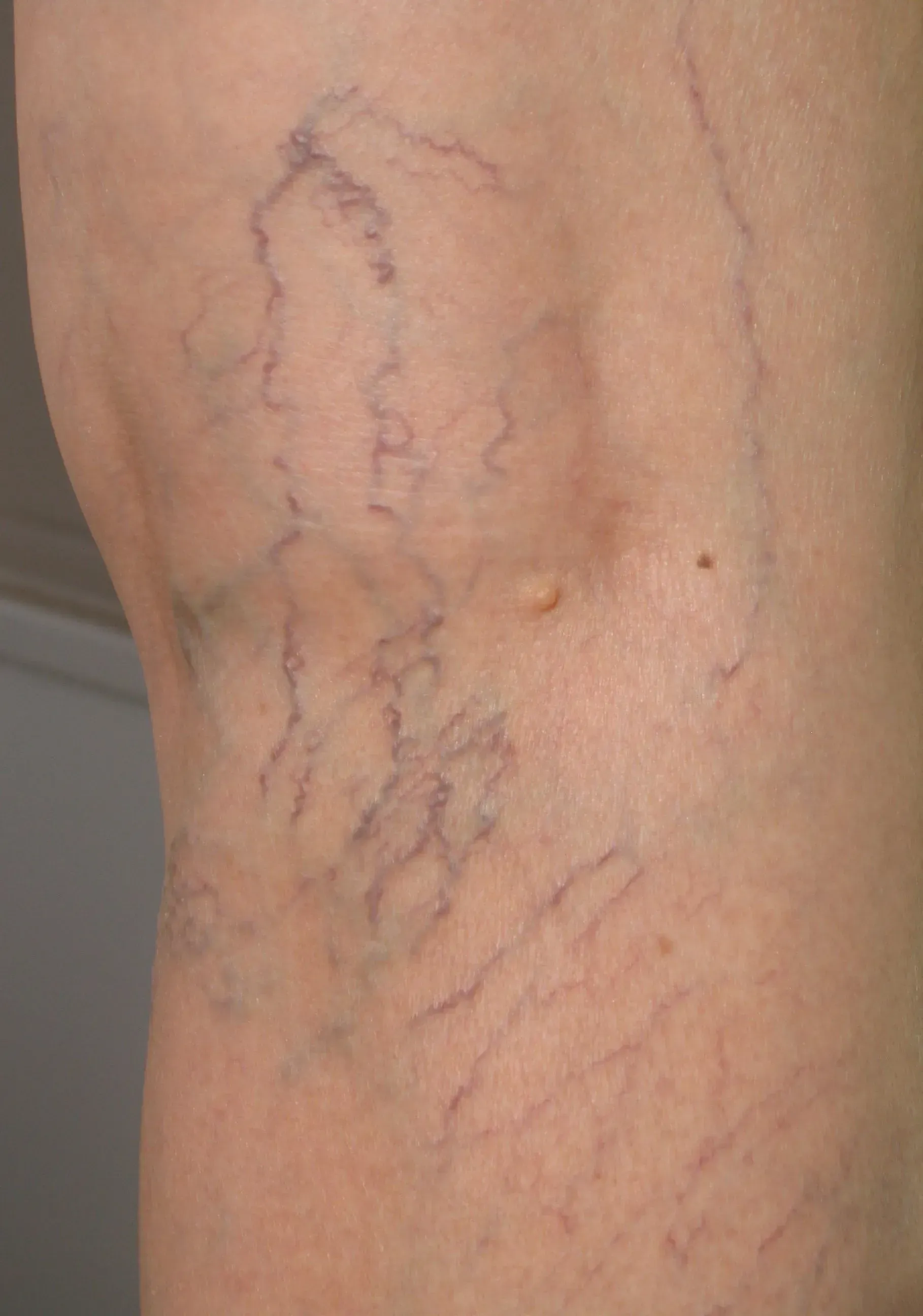 Close-up of a leg with visible blue-purple varicose veins on skin
