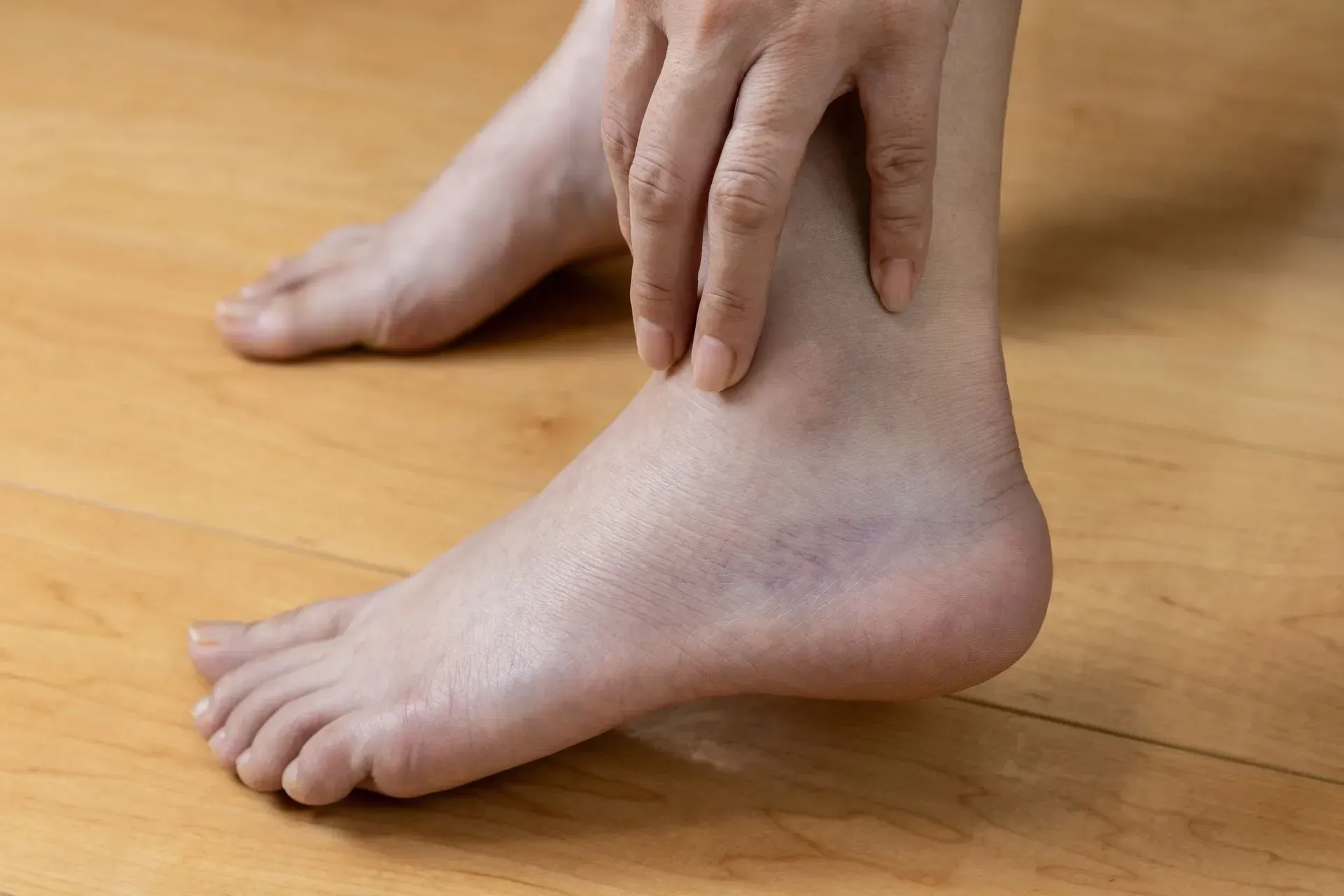 Hands holding an ankle on a wooden floor, showing a swollen, bruised foot and leg.