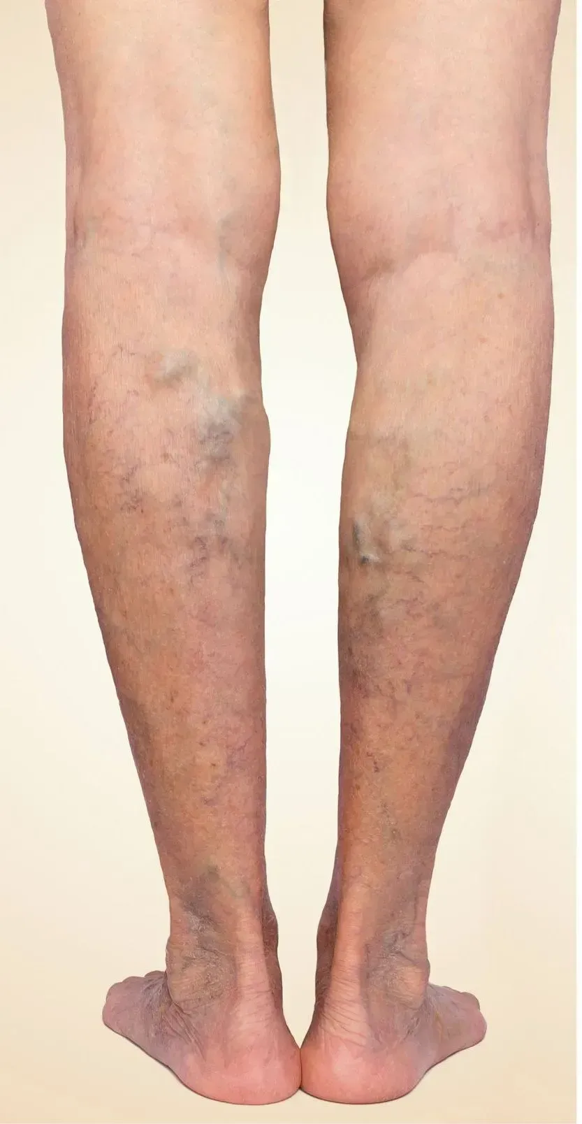 Back view of lower legs with visible blue varicose veins and red skin patches