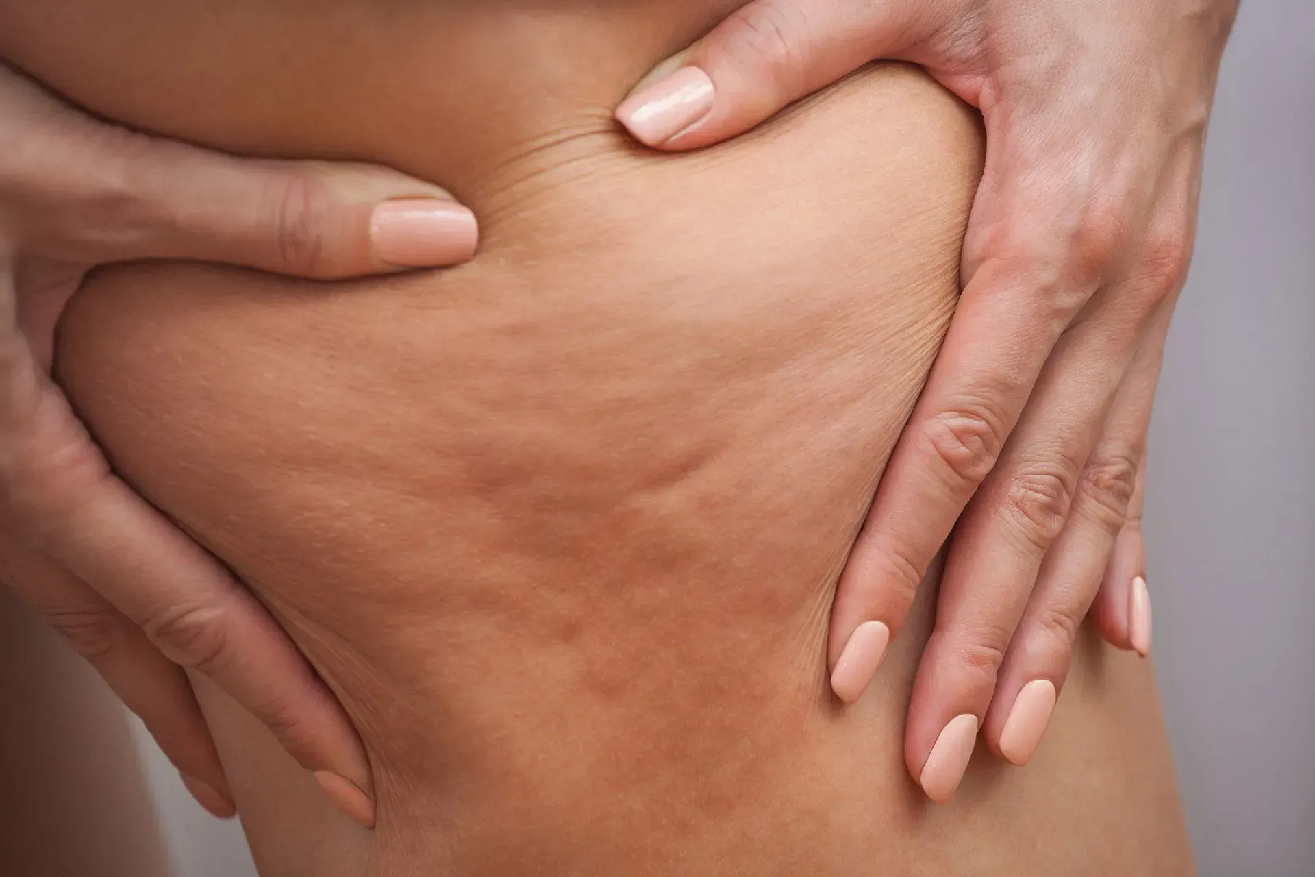 Close-up of hands pinching skin on a bare waist, showing cellulite.