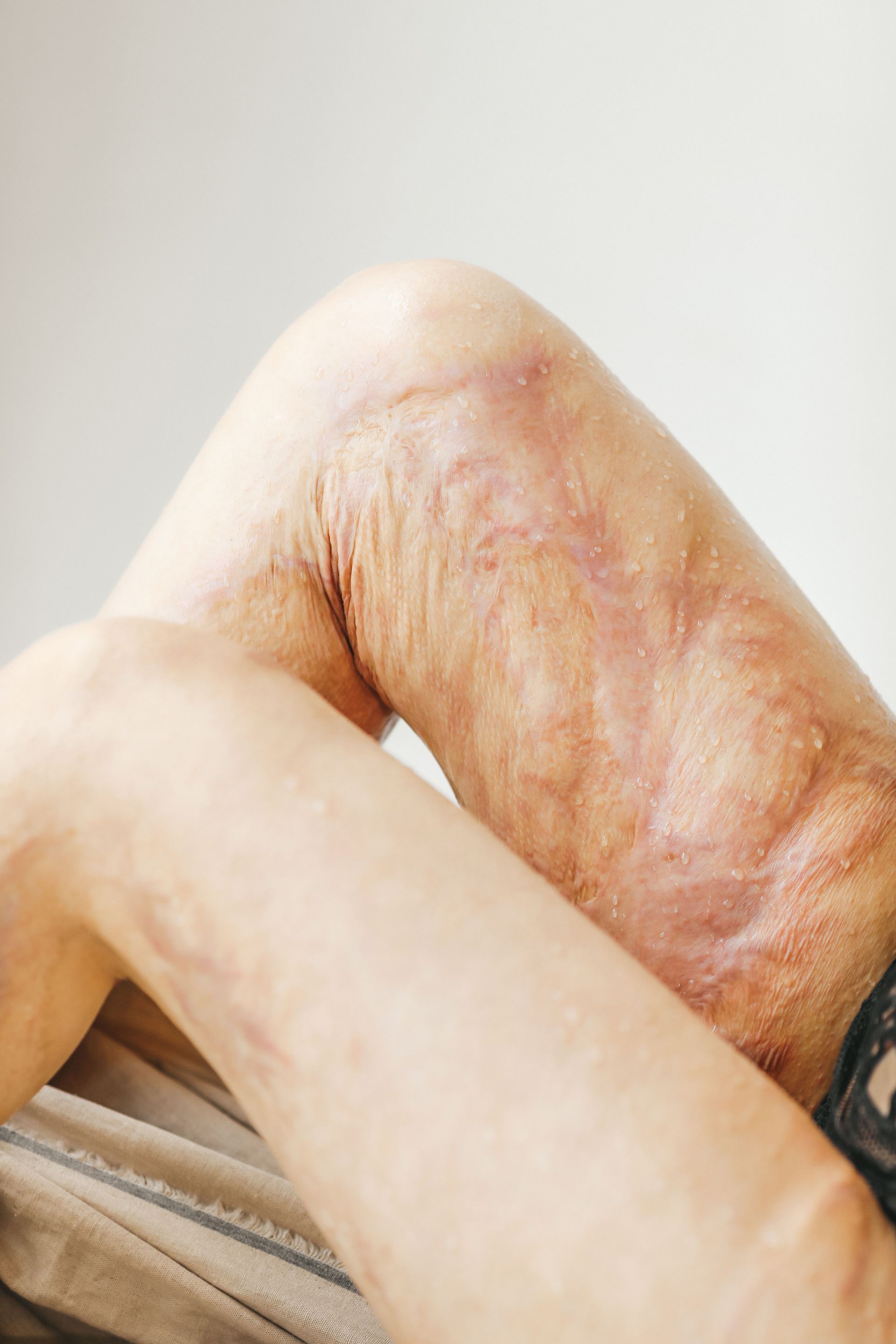 Close-up of a person’s bent arm with a large reddish scar or skin lesion on the leg area.