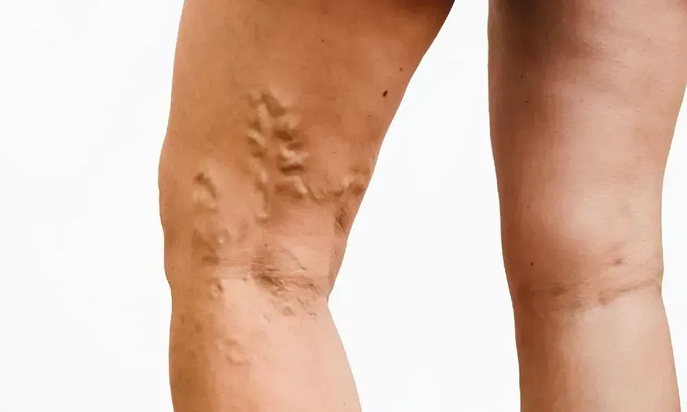 Close-up of two legs, one with visible varicose veins on the calf and knee.