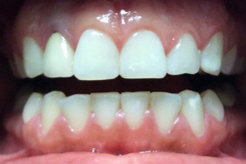 Zoom Whitening After