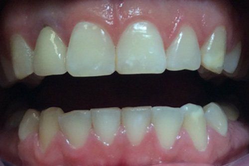 Zoom Whitening Before