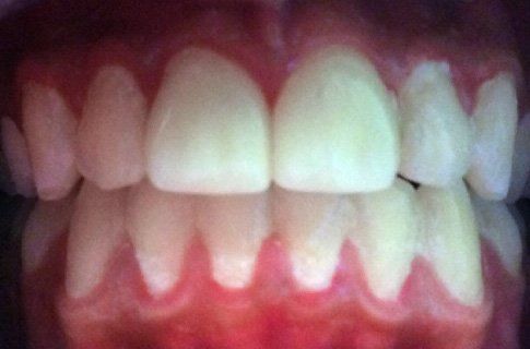 Ceramic Crowns After