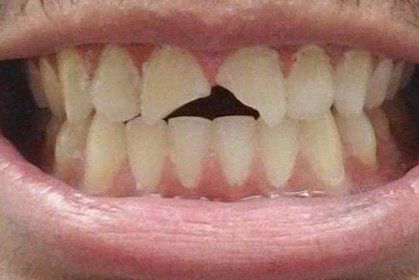 Ceramic Crowns Before