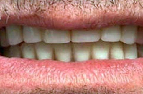 Full Dental Implants After