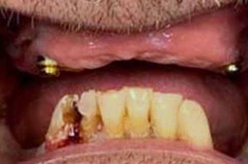Full Dental Implants Before
