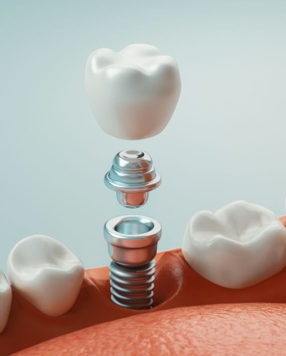 dental installation