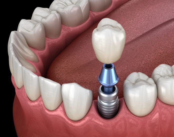 implantation