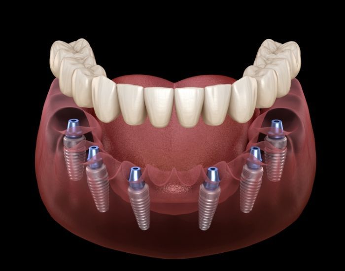 Single tooth implant
