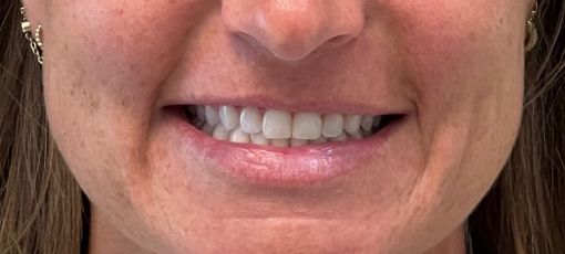 Teeth fixing
