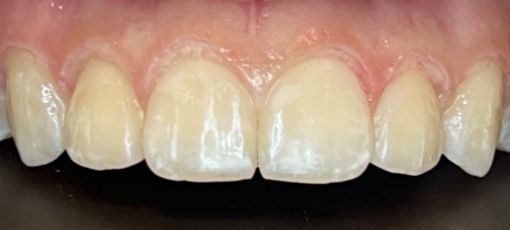 Teeth color