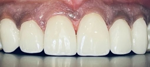 Teeth Arrangement