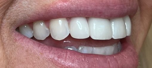 non-surgical tooth replacement