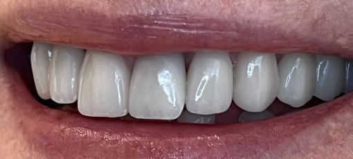 replace  teeth