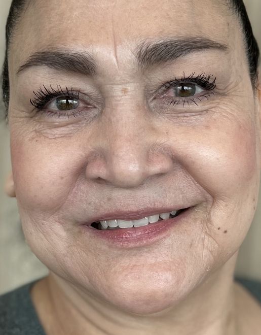 Teeth alignment
