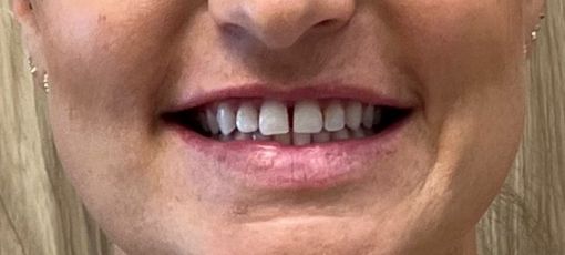Teeth placement