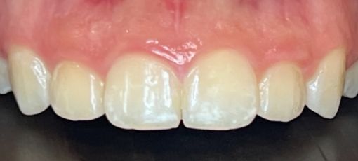 Teeth discoloration