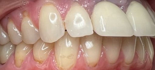 full mouth teeth replacement