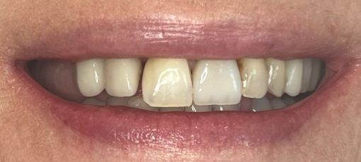 permanent tooth replacement