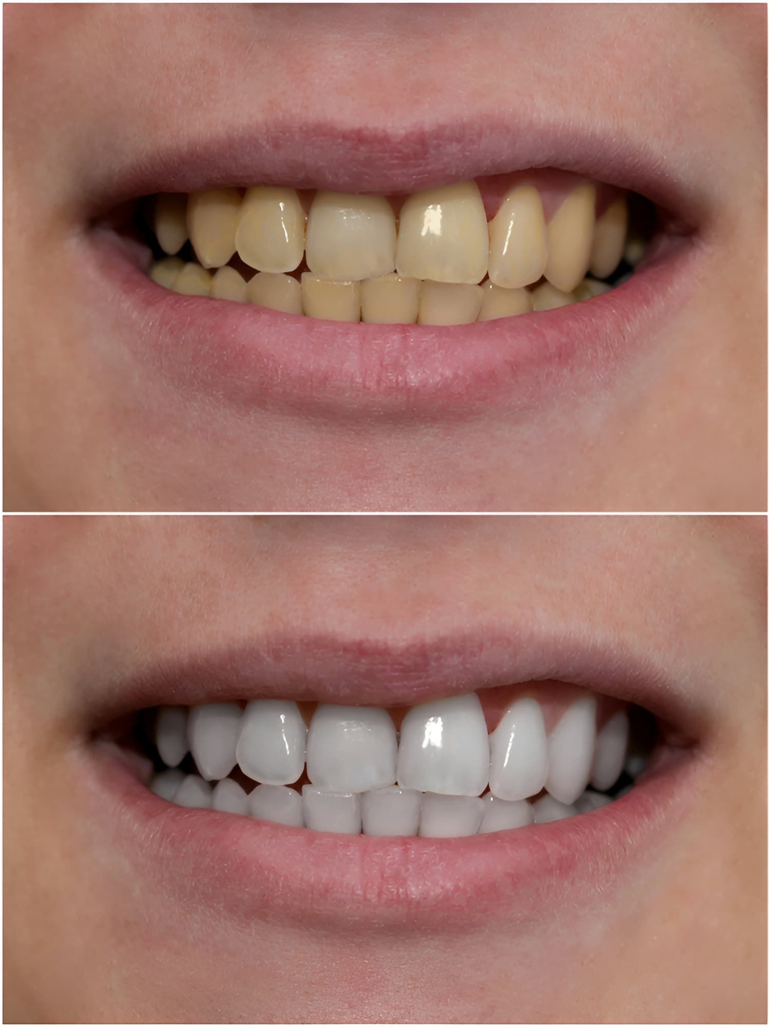A Before and After Photo of a Woman's Teeth — Advanced Dental Southern Highlands in Moss Vale, NSW