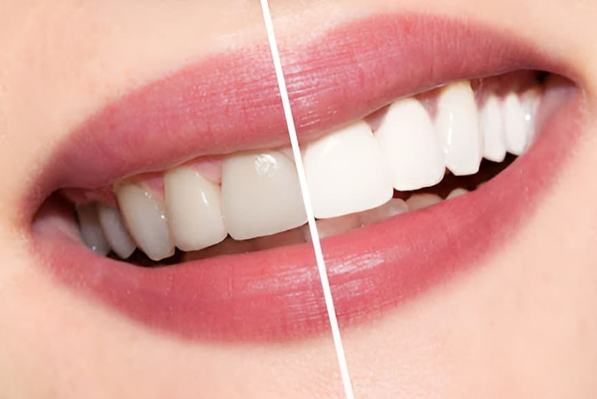 A Before and After Photo of a Woman's Teeth — Advanced Dental Southern Highlands in Moss Vale, NSW