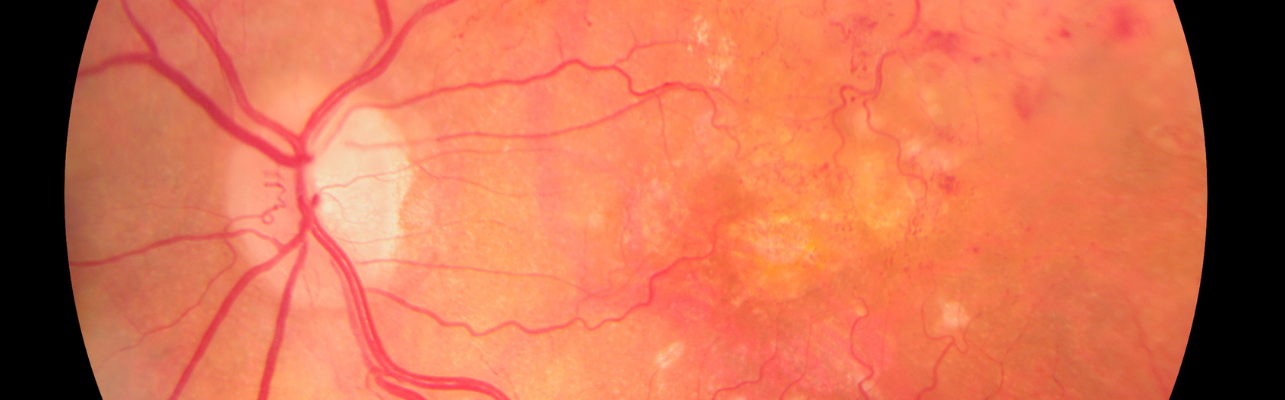 Diabetic Retinopathy | Eye Foundation of Utah | Service Page Diabetic Retinopathy | Eye Foundation of Utah | Service Page