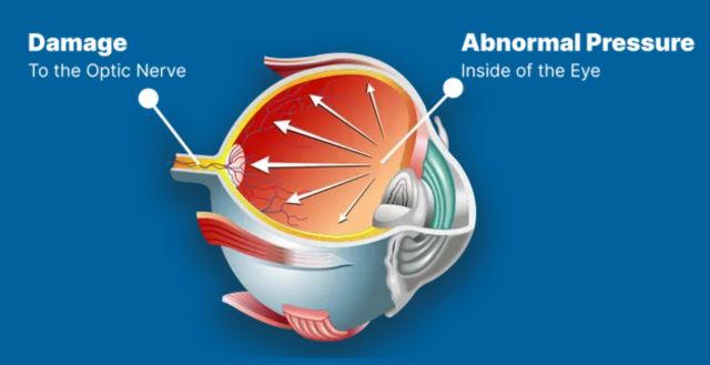 Glaucoma | Eye Foundation of Utah | Service Page Glaucoma | Eye Foundation of Utah | Service Page