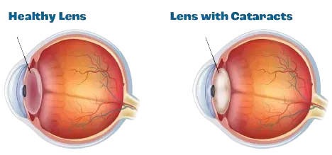 Cataract Surgery | Eye Foundation of Utah Cataract Surgery | Eye Foundation of Utah