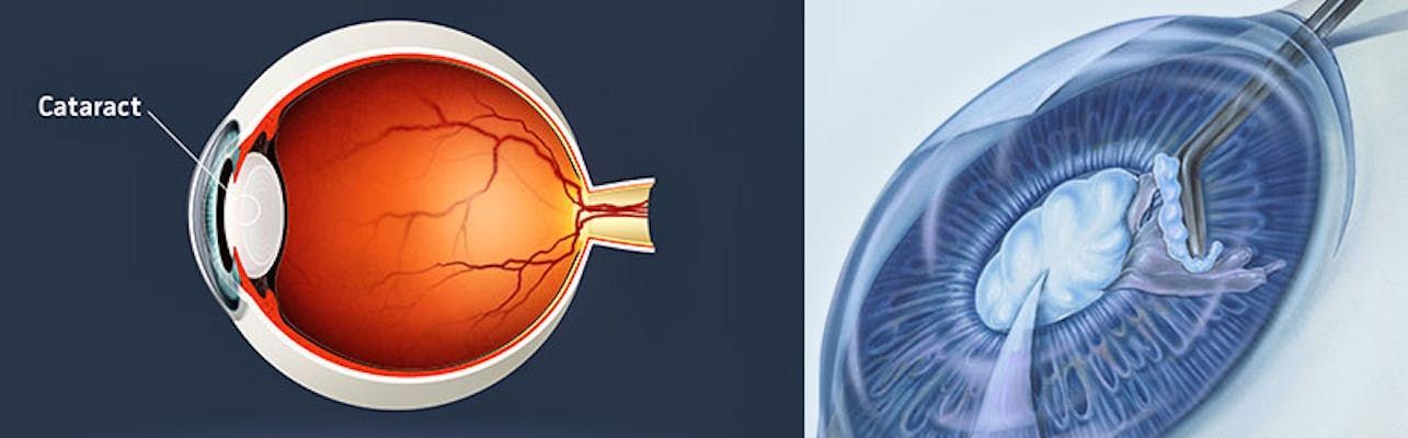 Cataracts | Eye Foundation of Utah | Service Page Cataracts | Eye Foundation of Utah | Service Page