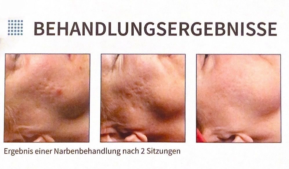 Das Gesicht einer Frau wird vor und nach einer Behandlung gezeigt