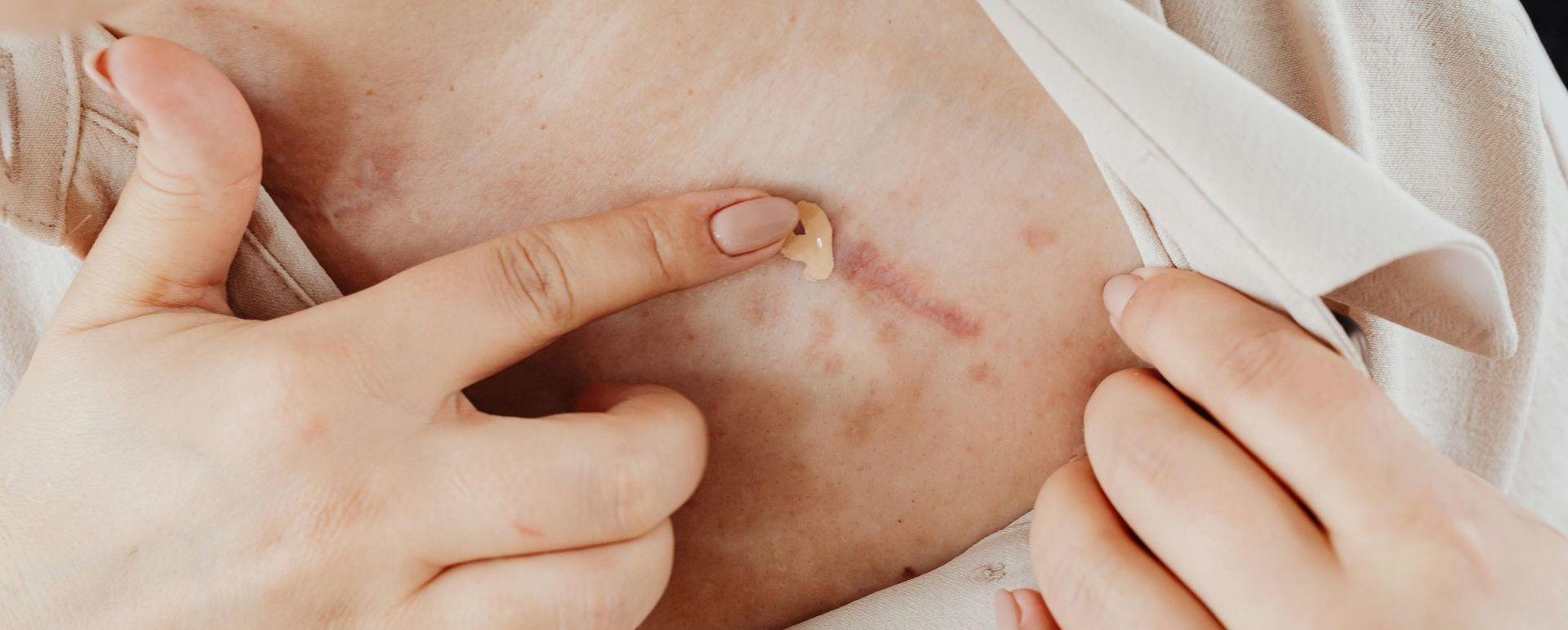 A person is pointing at a scar on their chest.