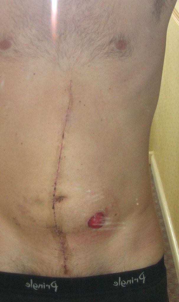 A man with a surgical scar on his stomach is wearing black underwear.