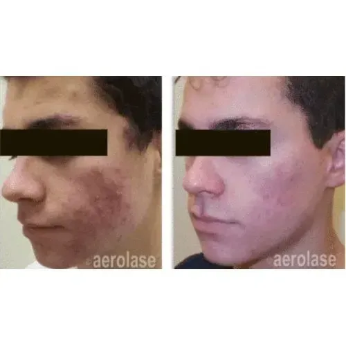 Before and after acne treatment for clearer facial skin, Skin & Tonic Pace FL
