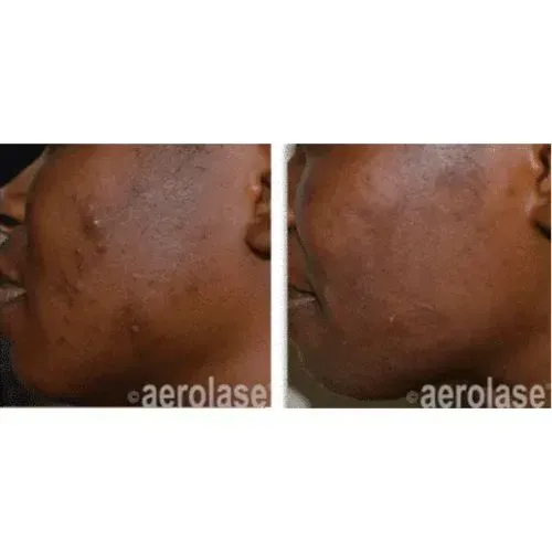 Before and after acne treatment for smoother cheek skin, Skin & Tonic Pace FL