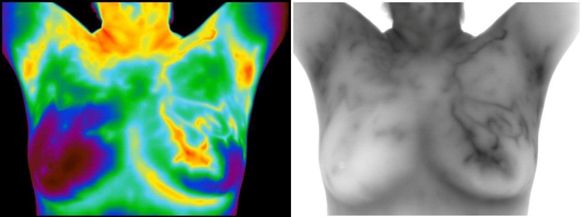 Thermogram and grayscale image of a person's chest, showing potentially increased heat patterns and vascular structures.