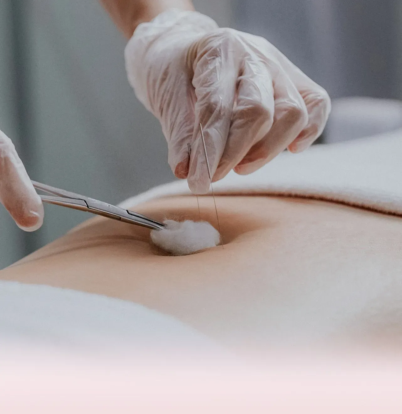 TCM Acupuncture Treatment