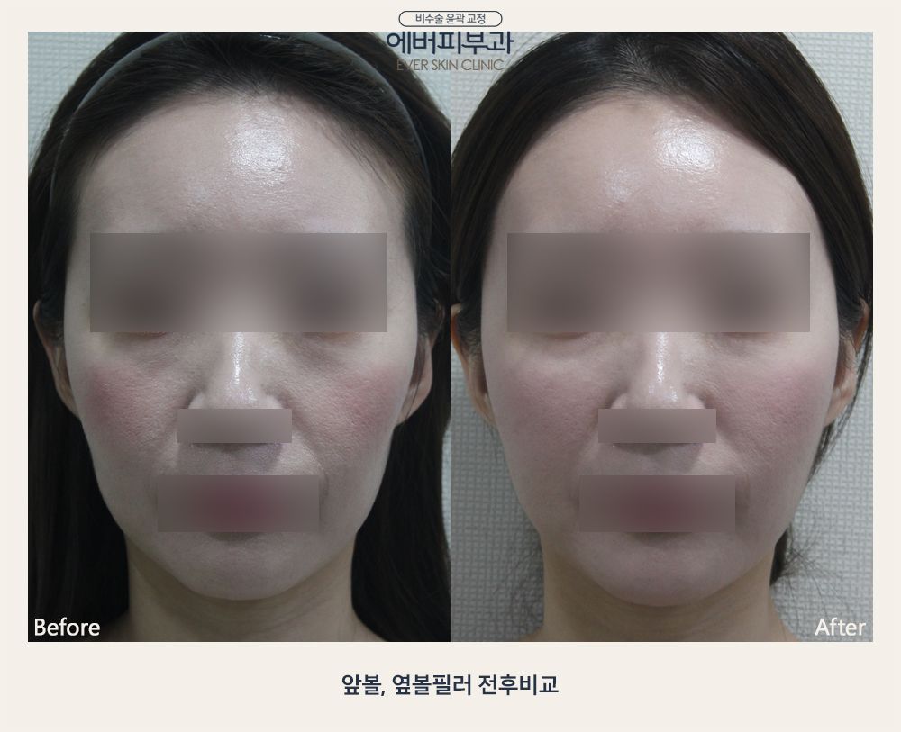 Cheek Filler before and after