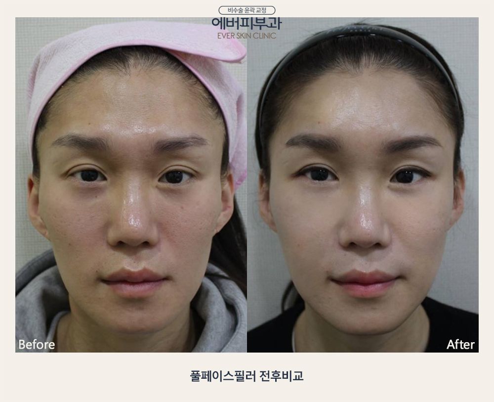 Full Face Filler before and after