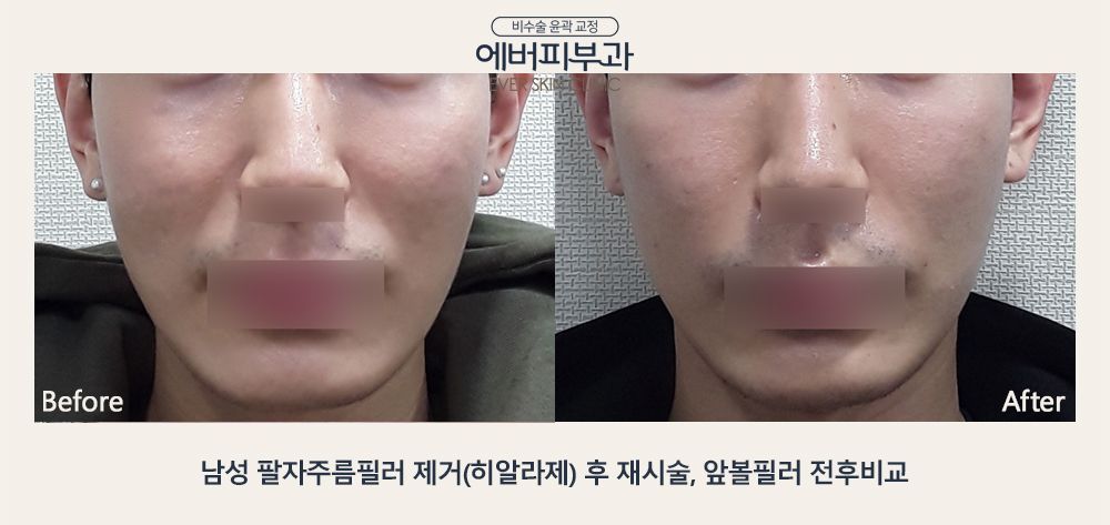 Smile Line Filler before and after
