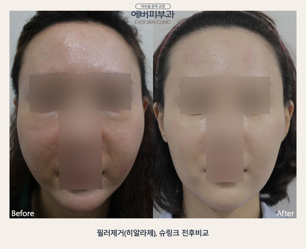Lifting · Whitening · Flush before and after