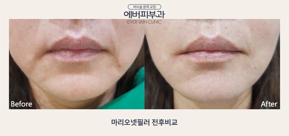 Marionette Line Filler before and after